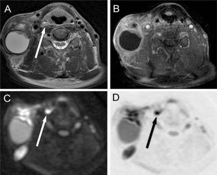 Ismeretlen primér TU T2 KaT1FS MP-MRI PET/CT Jobb N met, ADC DW DW T : jobb rec. piriformis T-ADC: 0.