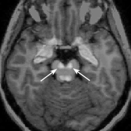 Prefrontalis cortex: magasabb szintű kogníció Dopaminerg neuronok: hisztológia