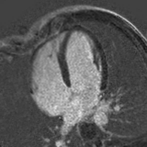 Szív MRI