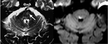 FLAIR Torvik A, Skullerud K. Watershed infarcts in the brain caused by microemboli. Clin Neuropathology (1982; 1/3): 99-105.