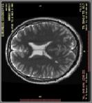 érhálózatban intravascularis nyomás megemelkedik IC Vénás érhálózat Ckeringési megbetegedése Cerebralis Sinusok thrombosisa Cavernosus Sinus (SV) Sagittal Superior Sinus