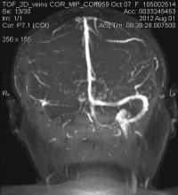 Diagnostics of the Recent Imaging Technique in cases of Intracranial Tumours.