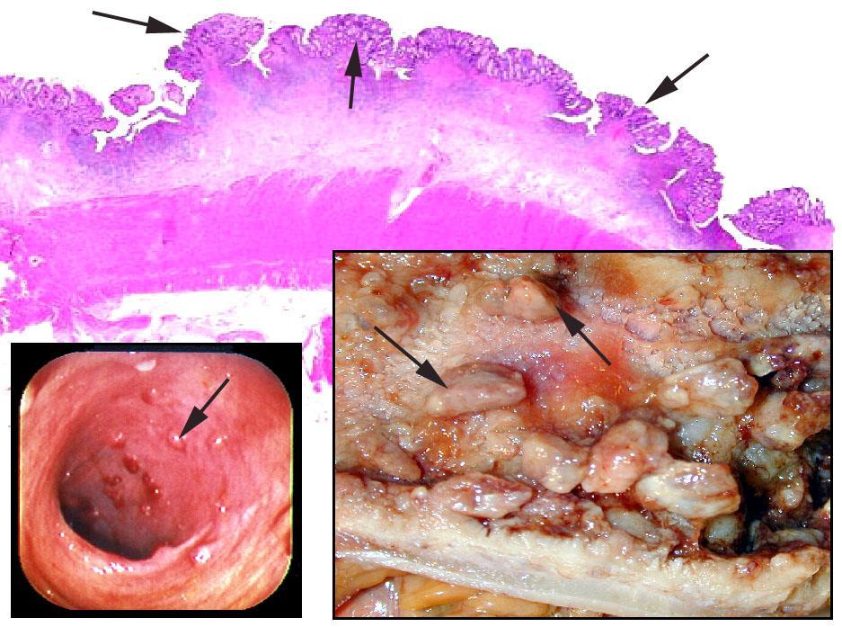 Colitis ulcerosa