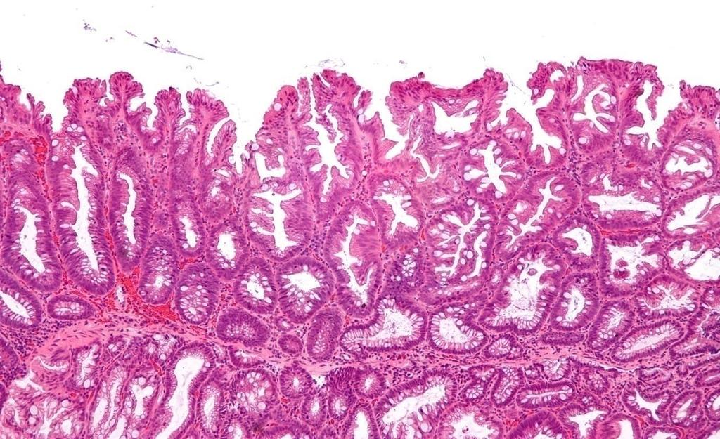 NEOPLASTICUS POLYPUSOK- II.