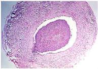 Iatrogen ártalom (phlebitis = érfal gyulladás) Endocarditis/osis