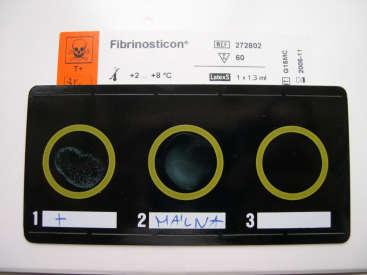 D-dimer latex test 47 Concordia parvao crescunt, discordia et magnae dilabuntur.