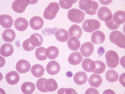 A thrombocyták rendellenességei (= thrombocytopathiák) Fokozott thrombocyta funkció. Thrombocytosis esszeciális thromobocythemia, stb. A fokozott vérlemezke funkció thrombusképződéssel jár.