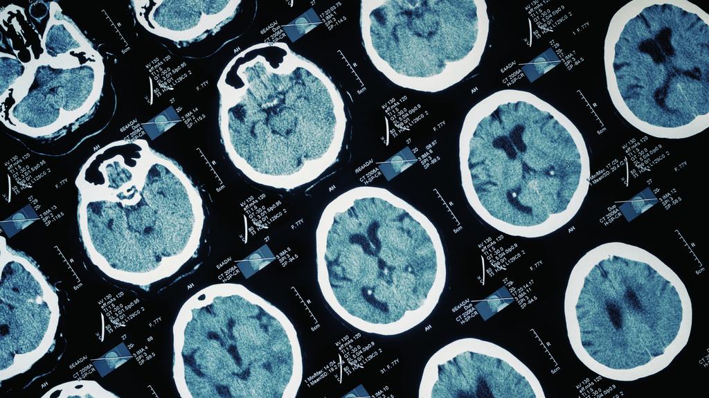 -- KOPONYASÉRÜLÉSEK Az agy nem felejt A központi idegrendszer betegségeivel foglalkozó egyik legszínvonalasabb nemzetközi folyóirat, a Lancet Neurology 2017-ben külön szerkesztőségi témaként