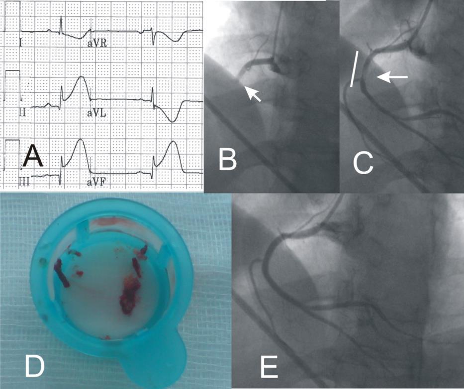 EKG STEMI
