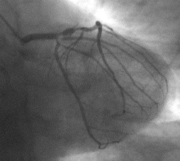 1 hetes crescendo angina TropT 20.