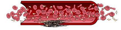 Haemostasis (vérzéscsillapodás) Tanulási segédlet 14-16 Komponensei: Érfal Thrombocyta (vérlemezke) Vérplazma