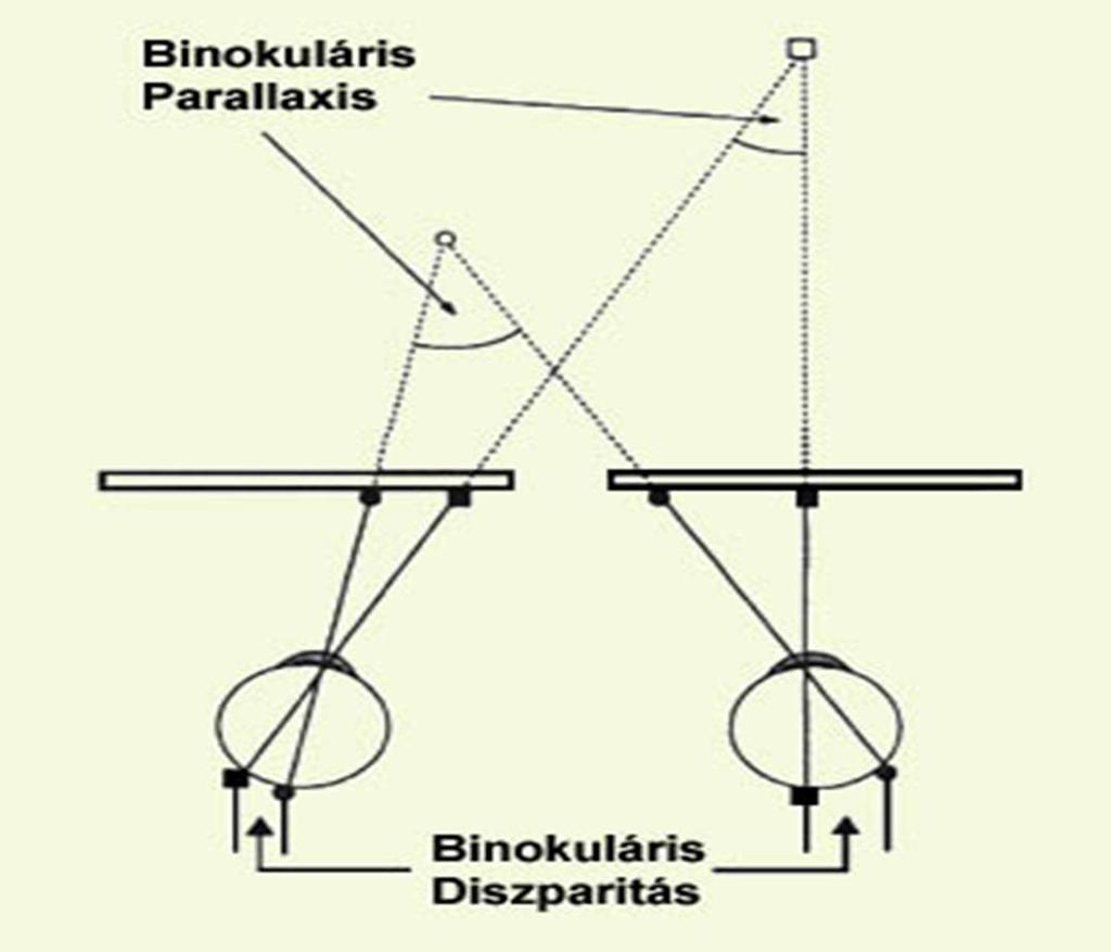diszparitás (retinakép eltérései)