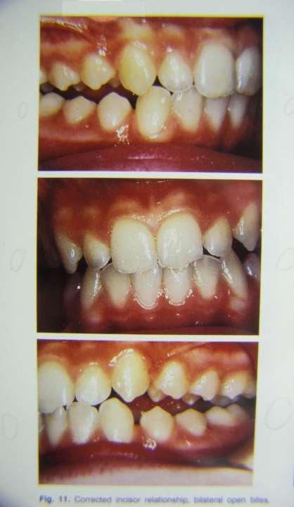 Functional jaw orthopaedics A vertikális