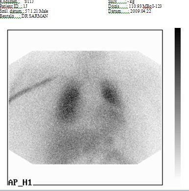 I-123 MIBG szcintigráfia eset II NYHA: