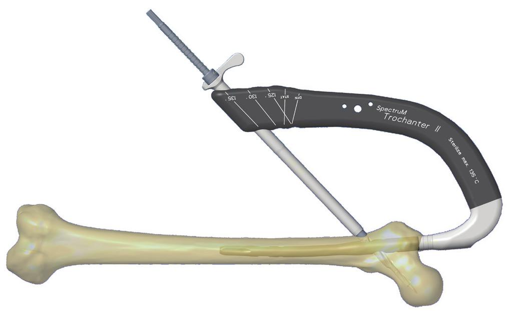 drótot a subchondralis zónától 5 mm-re. 3.