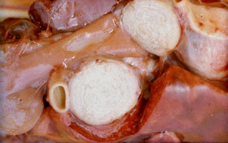 Caseatio, elsajtosodás Zsíros elfajulás előzi meg Lipochromok