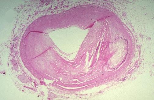 atheroma