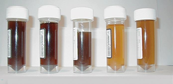 2. Paroxizmális nokturnális hemoglobinuria 1-2 eset / 1,000,000 fő / év 10-20 év várható