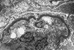 4. Dense deposit disease (DDD) ritka, súlyos vesebetegség a plazma komplementreguláció hibájával asszociált (alacsony C3 szint) Licht et al. (2006) Kidney Int. 70:42-50.