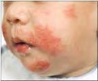 pediatric asthma Allergy 2012. 67. 976-997.