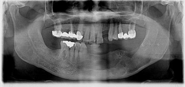 OP-078 Odontogenic Kearatocyst: A Case Report Ozan Kaan Venedik, Serpil Altundoğan, Murat Kaan Erdem Department of Oral and Maxillofacial Surgery, Ankara University, Ankara, Turkey Objective: An