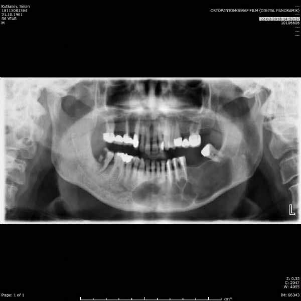 preop and postop orthopantomograph