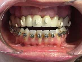 OP-085 The Effect of Missing Teeth or Existing Prostheses on Orthodontic Treatment Duration of Skeletal Class III Orthognathic Surgery Patients Banu Kilic Bezmialem Vakıf Üniversitesi, Ortodonti Ana