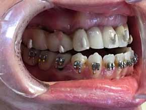 time when orthodontic treatment was started and the time when the patients were decided to be ready for the surgery determined retrospectively Materials-Methods: The effect of the amount of tooth