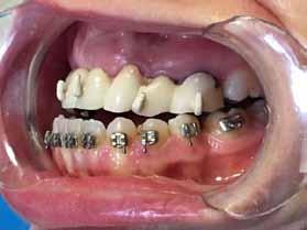 Picture 3 Picture 4 Patient with more than 10 prosthesis ready for surgery buccal: left.