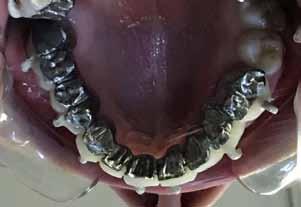 surgery lower occlusal Table 1 Group Shapiro-Wick statistics n p Control group,904 15,111 Time 1 tooth deficiency,929 8,510 2 or
