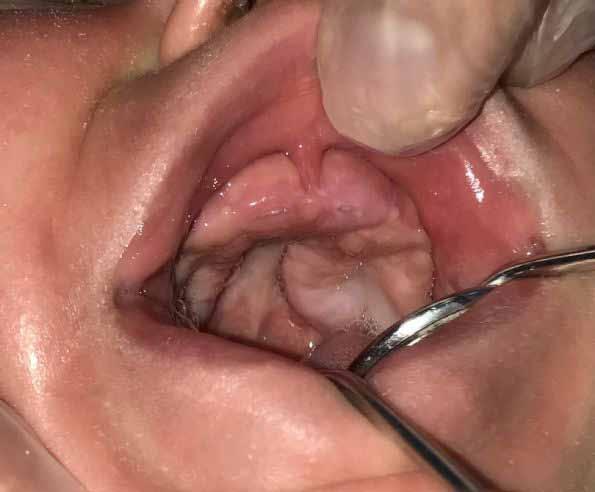 intraoral  -