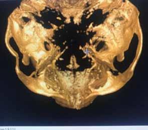 OP-115 Closed Reduction Of The Fractured Arcus Zygoma By A Hook Traction Utku Nezih Yılmaz Dicle Üniversitesi Diş Hekimliği Fakültesi, Ağız Diş ve Çene Cerrahisi Ana Bilim Dalı, Diyarbakır Objective: