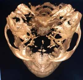 Ten percent of all zygomaticomaxillary complex fractures are zygomatic arch fractures only.