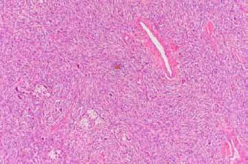 cells with interspersed staghorn