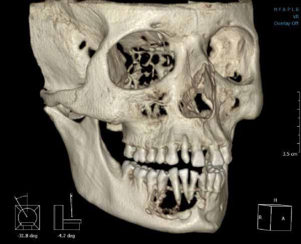 PP-010 Cemento-Ossifying Fibroma (COF) of the mandible: A case report Osman Akıncı, Ramazan Arslan, Emrah Mansuroğlu, Poyzan Bozkurt, Muhsin Ardıç, Reha Şükrü Kişnişci Oral and Maxillofacial Surgery