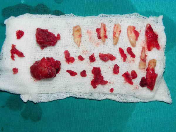 the lesion Surgical specimen Image
