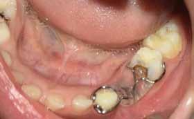 PP-016 Eruption of Impacted Permanent Teeth after Treatment of a Dentigerous Cyst: A Case Report Rıdvan Güler, Bekir İlyas, Kamil Serkan Ağaçayak Dicle University, Faculty of Dentistry, Departmant of