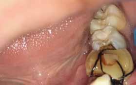 It is a benign and asymptomatic intraosseous lesion that affects the bones of the maxillofacial complex, interfering with tooth eruption.