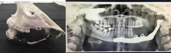 PP-019 Custom-made prostheses for temporomandibular joint reconstruction after partial excision of mandible due to Ameloblastoma Ali Ekemen, Orkhan Ismayilov, Mikail Kadyrov, Raha Akbarihamed, Hakan