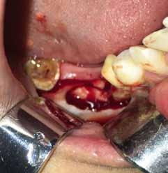 PP-024 Floride cemento-osseous dysplasia of the mandible: A case reports Rıdvan Güler, Bekir İlyas, Kamil Serkan Ağaçayak Dicle University, Faculty of Dentistry, Departmant of Oral and Maxillofacial