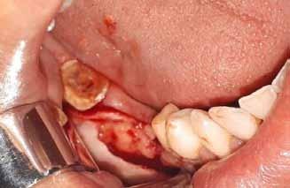 Florid cemento-osseous dysplasia is a multifocal dysplastic lesion and consist of cellular fibrous connective tissue with bone and cementum-like tissue.