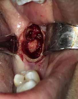 intraoperative