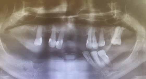 PP-039 Prosthodontic treatment of the edentulous mandible with a 6 implanted supported toronto prosthesis: a case report Melahat Çelik, Güven 1, Gülhan Yıldırım 1, Burak Ergüder 2, Tayfun Cıvak 2 1