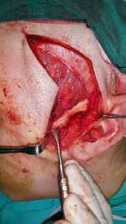 PP-045 A CASE REPORT: Bilateral Eminectomy Surgery for Recurrenet Tmj Dislocation Orkhan Ismayilov, Ali Ekemen, Burak Mahir Maho, Murad Osmanlı, Hakan Alpay Karasu Ankara University, Faculty of