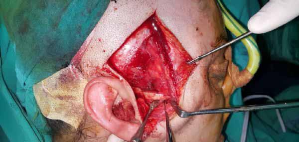 after eminectomy