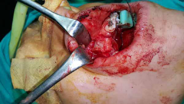 PP-047 The Reconstructıon of Alveolar Cleft with Iliac Bone Graft Orkhan Ismayilov, Ali Ekemen, Fırat Aksun, Irem Alan, Hakan Alpay Karasu Ankara University, Faculty of Dentistry, Department of Oral