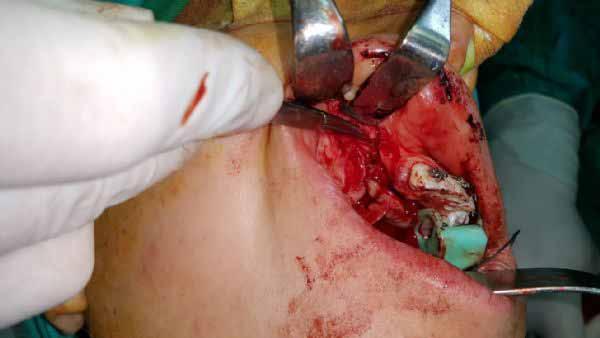 flap of nasal
