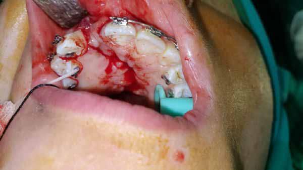 side preoperative