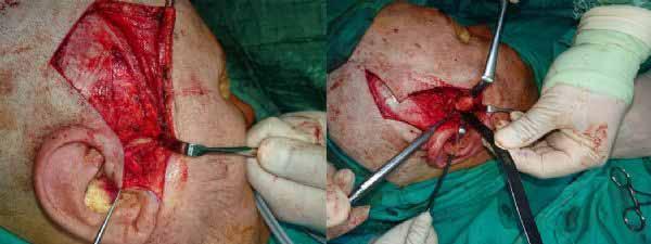 PP-048 A Case Report: Condylectomy Surgery Due to Grade I Chondrosarcoma Ali Ekemen, Orkhan Ismayilov, Mikail Kadyrov, Fırat Aksun, Hakan Alpay Karasu Ankara University, Faculty of Dentistry,
