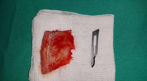 PP-049 Reconstruction of the mandibular crest with iliac bone in the horizontal inadequacy after keratocyst enucleation Ali Ekemen, Orkhan Ismayilov, Murad Osmanlı, Bülent Kahraman, Hakan Alpay